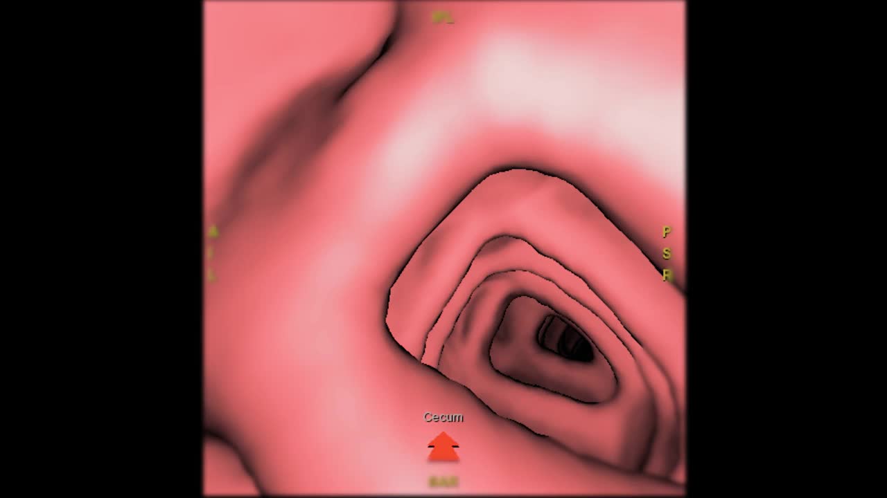 CT结肠镜三维绘制用于大肠癌筛查。筛查结肠癌。视频素材