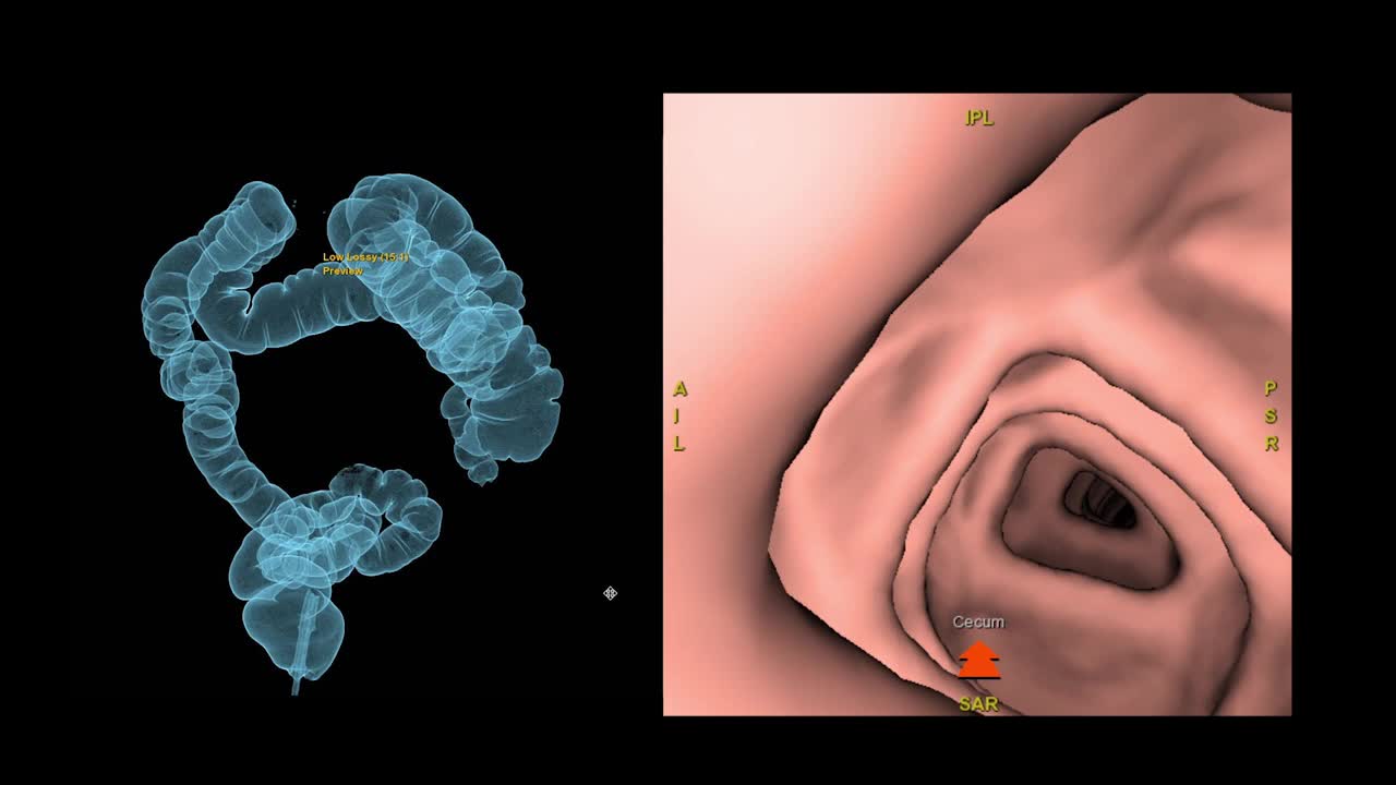 CT结肠镜三维绘制用于大肠癌筛查。筛查结肠癌。视频素材