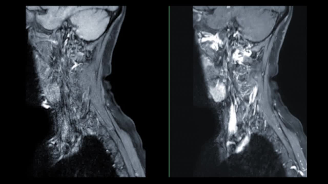 MRI c -脊柱或颈椎磁共振图像。视频素材