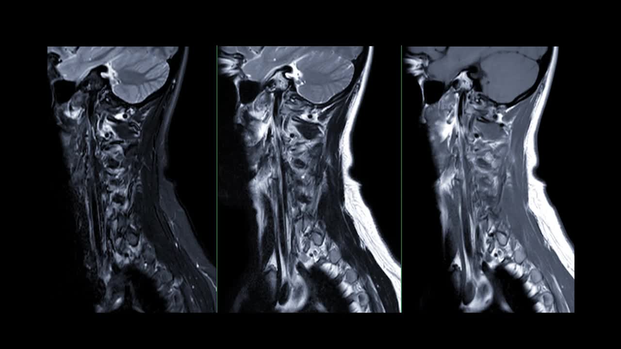 MRI c -脊柱或颈椎磁共振图像。视频素材