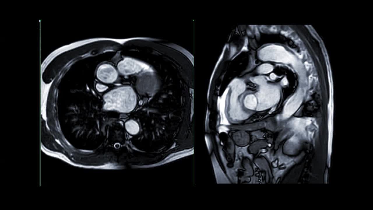 心脏MRI或心脏MRI(心脏磁共振成像)显示心脏跳动，以检测心脏病。视频素材