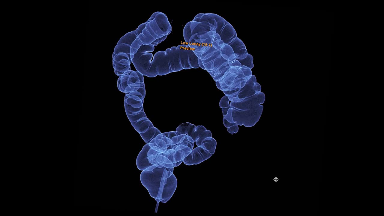 CT结肠镜三维绘制用于大肠癌筛查。筛查结肠癌。视频素材