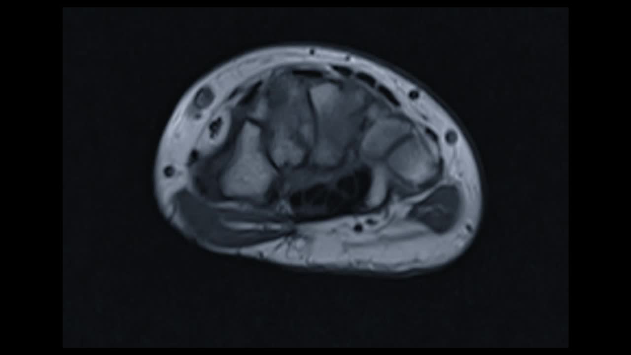 MRI腕关节诊断类风湿性关节炎。视频素材