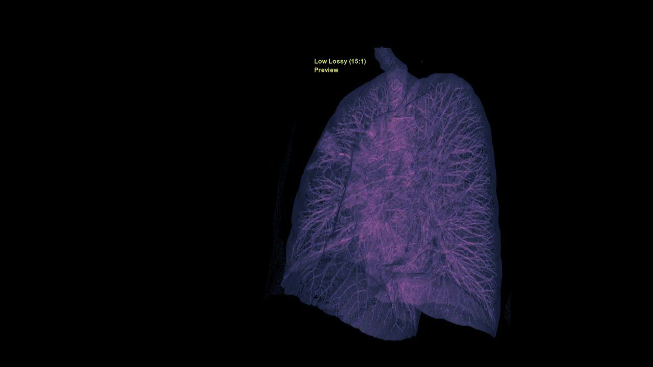 CT胸部或肺部三维渲染图像在屏幕上旋转，用于诊断结核病、结核病和covid-19。视频素材