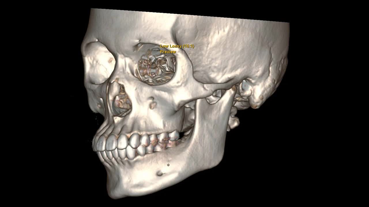 创伤患者颅骨或面骨的CT扫描三维图像在屏幕上旋转。医疗技术的概念。视频素材