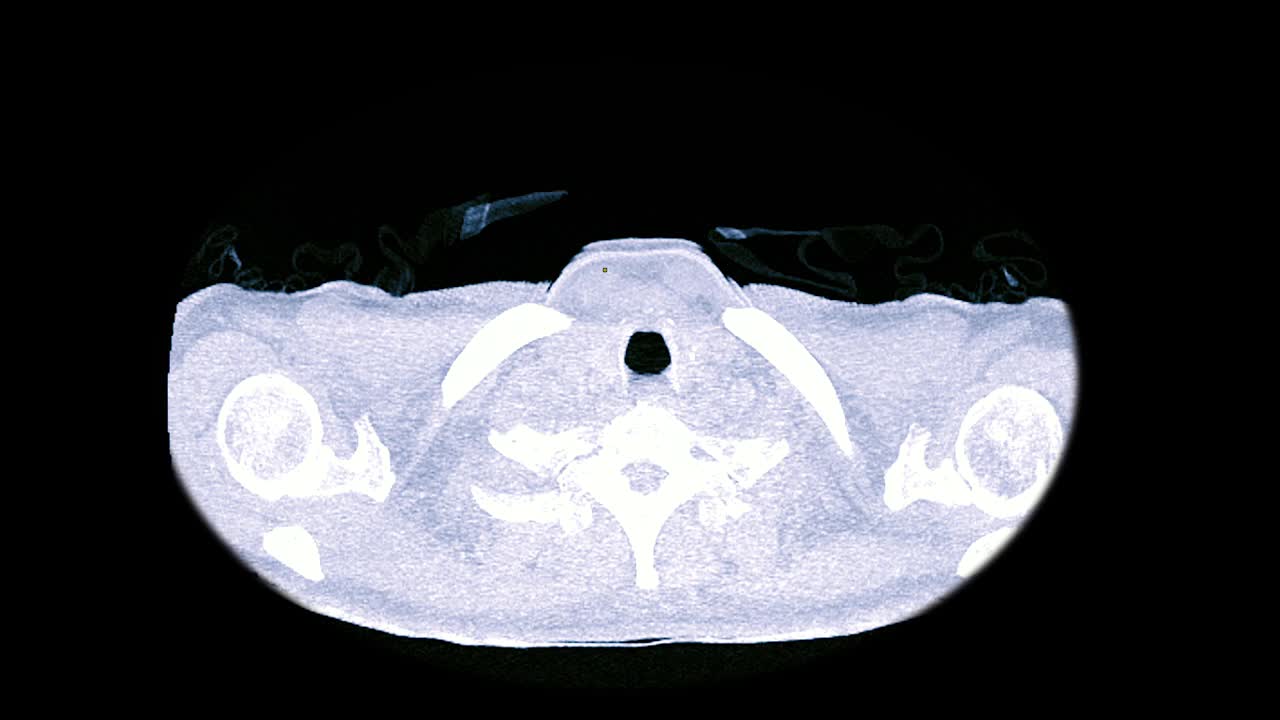 CT胸部或肺轴位mip视图用于诊断结核病、结核病和covid-19。视频素材