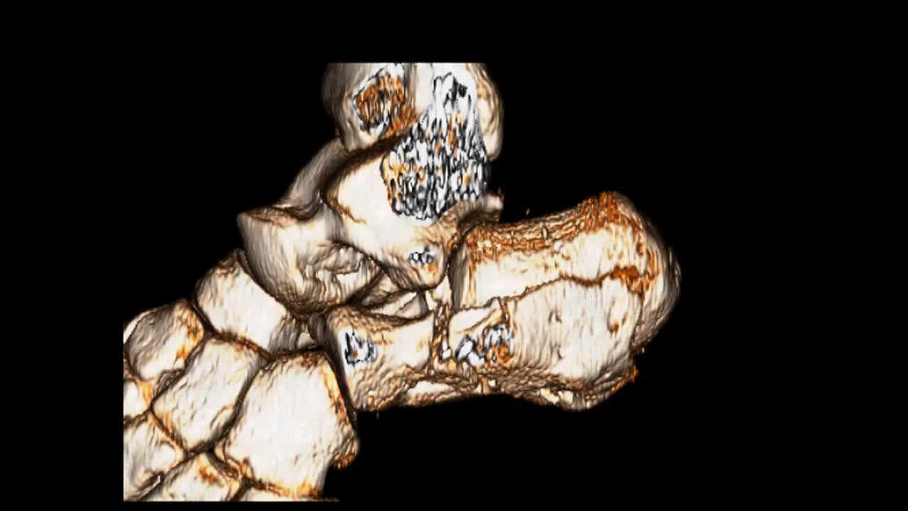 CAT扫描图像足部三维渲染。视频下载