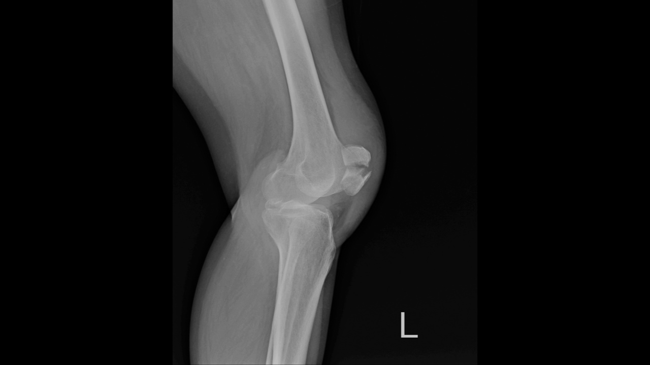 膝关节x线骨折髌骨视频下载