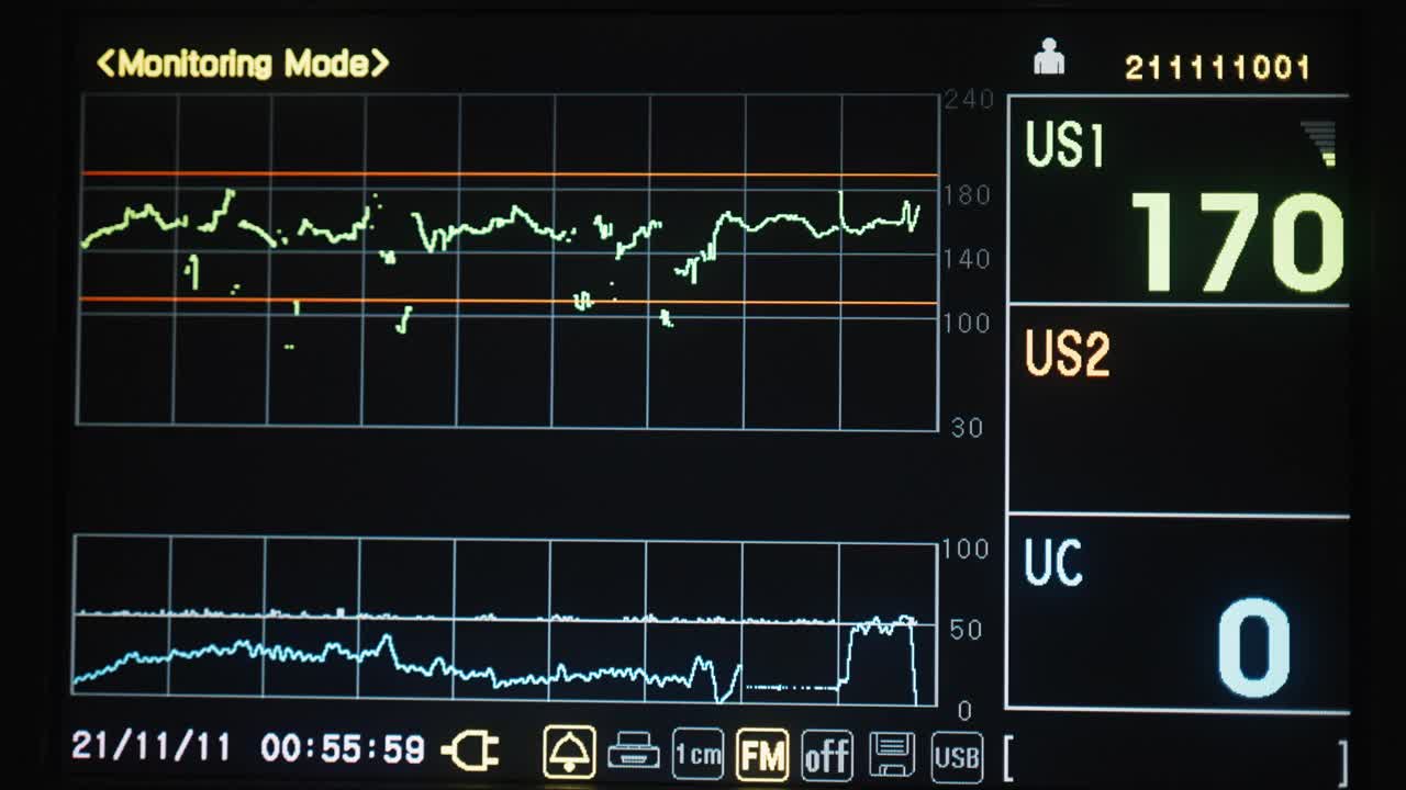 视频心血管内科ICU监护仪与住院患者生命体征视频素材