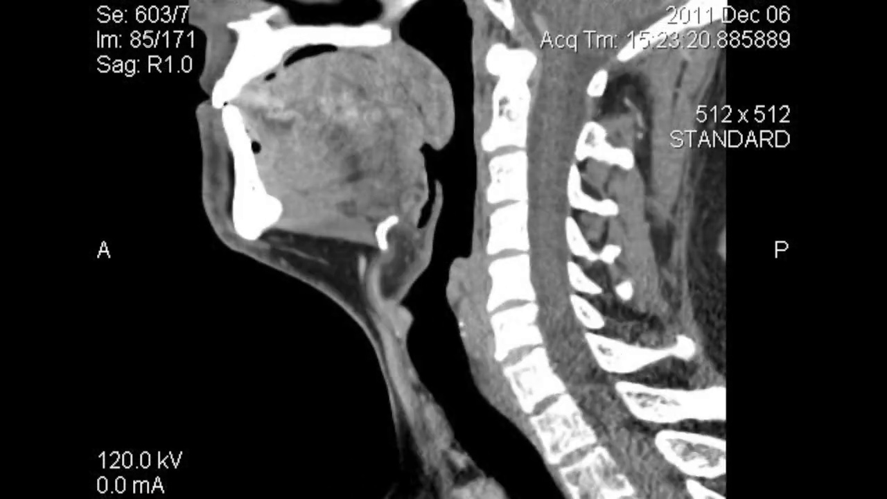 人颈部矢状面CT扫描视频素材