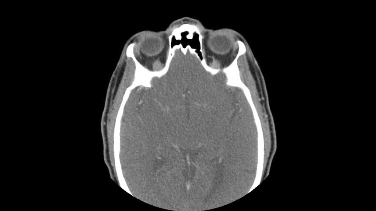 轴向CT头部扫描视频素材