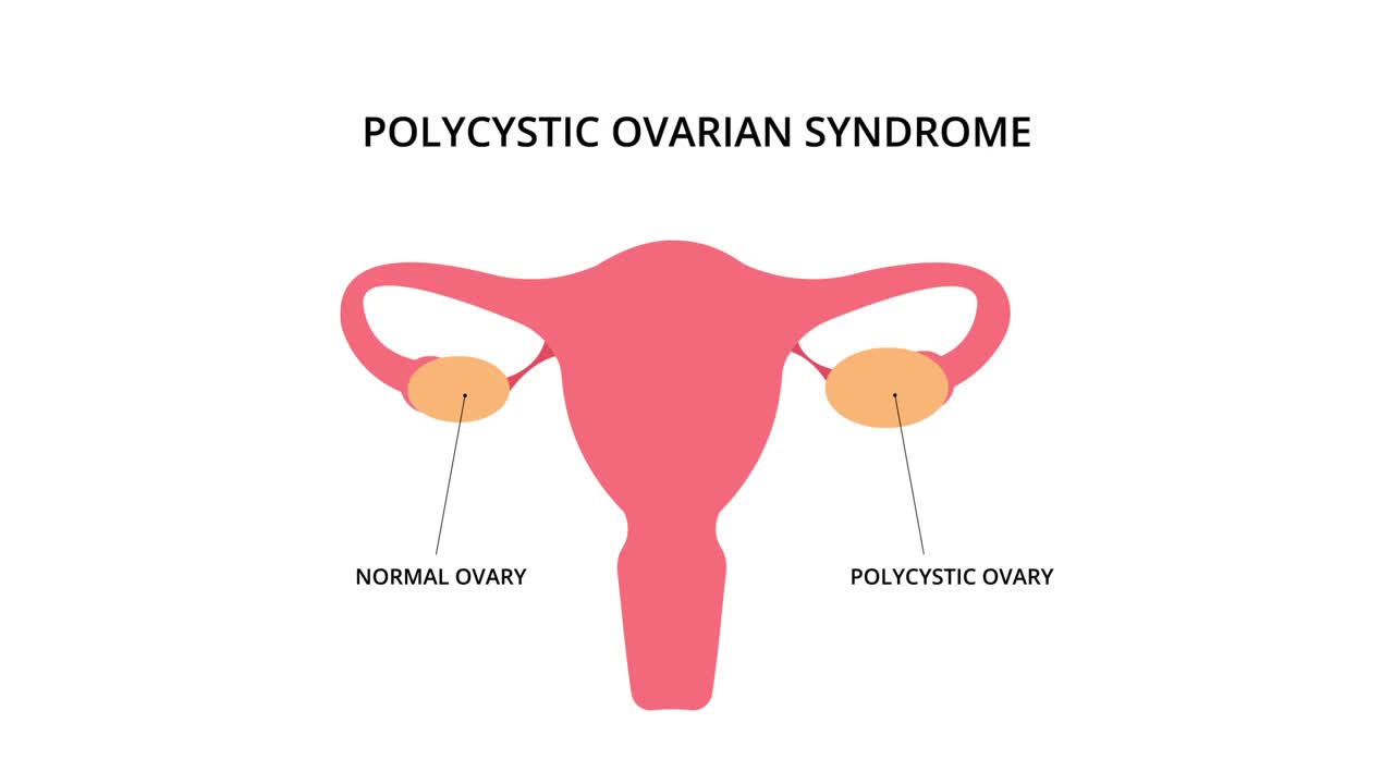 多囊卵巢综合征2D动画视频素材