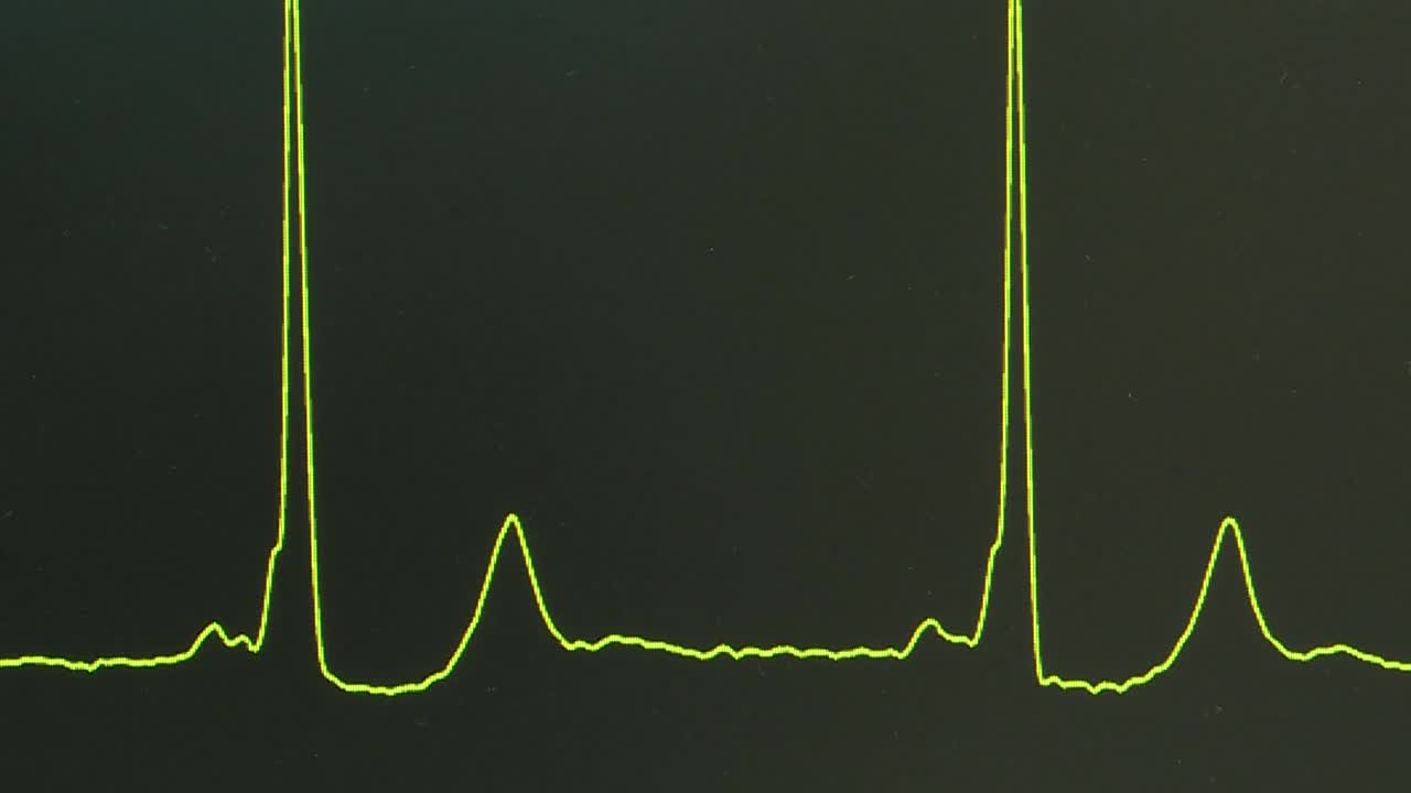 监视器上的心跳线。视频素材