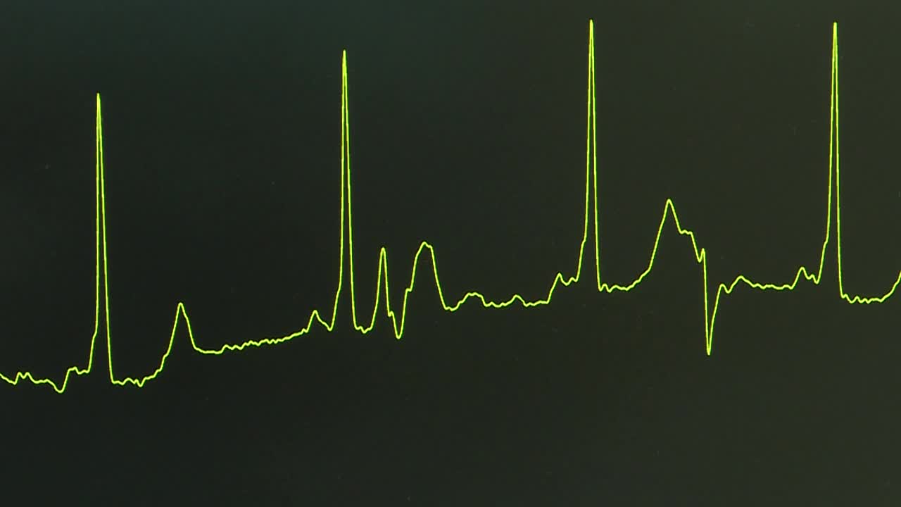 监视器上的心跳线。视频素材