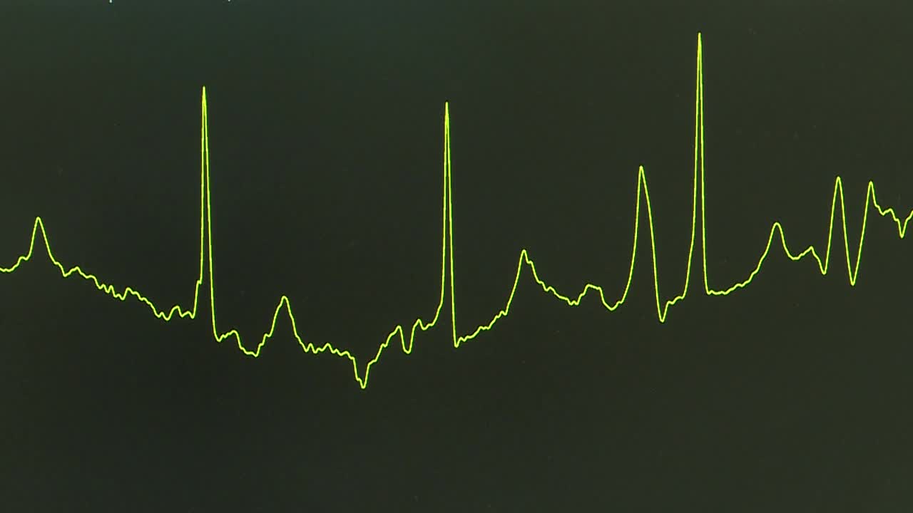 监视器上的心跳线。视频素材