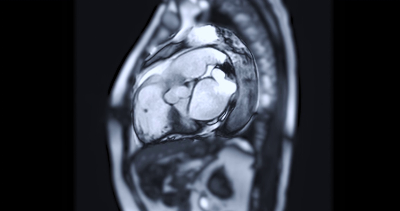 心脏MRI或心脏MRI(磁共振成像)。视频素材