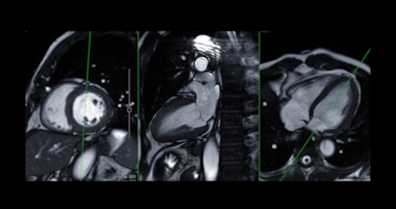 心脏MRI或心脏MRI(磁共振成像)。视频素材