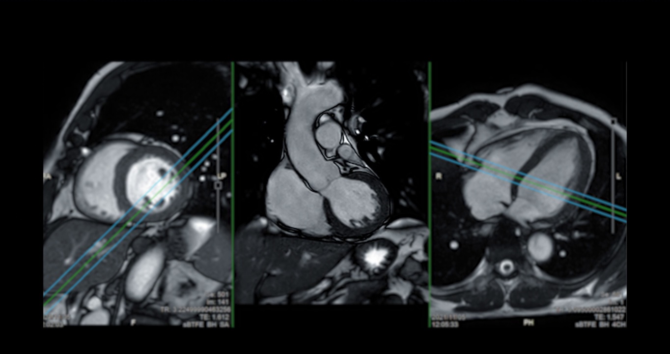 心脏MRI或心脏MRI(磁共振成像)。视频素材