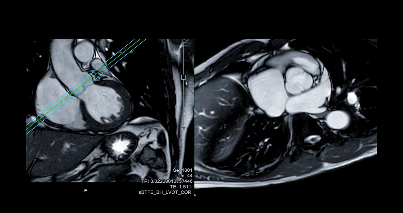 心脏MRI或心脏MRI(磁共振成像)。视频素材