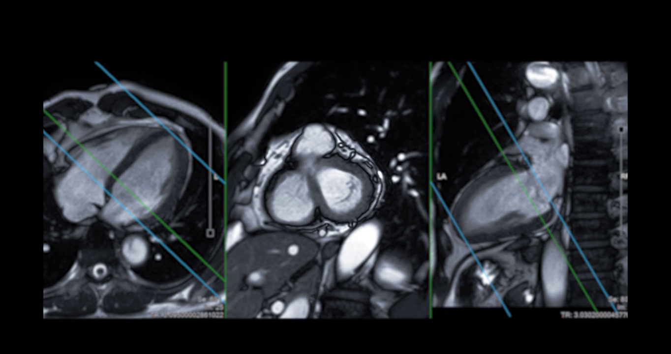 心脏MRI或心脏MRI(磁共振成像)。视频素材