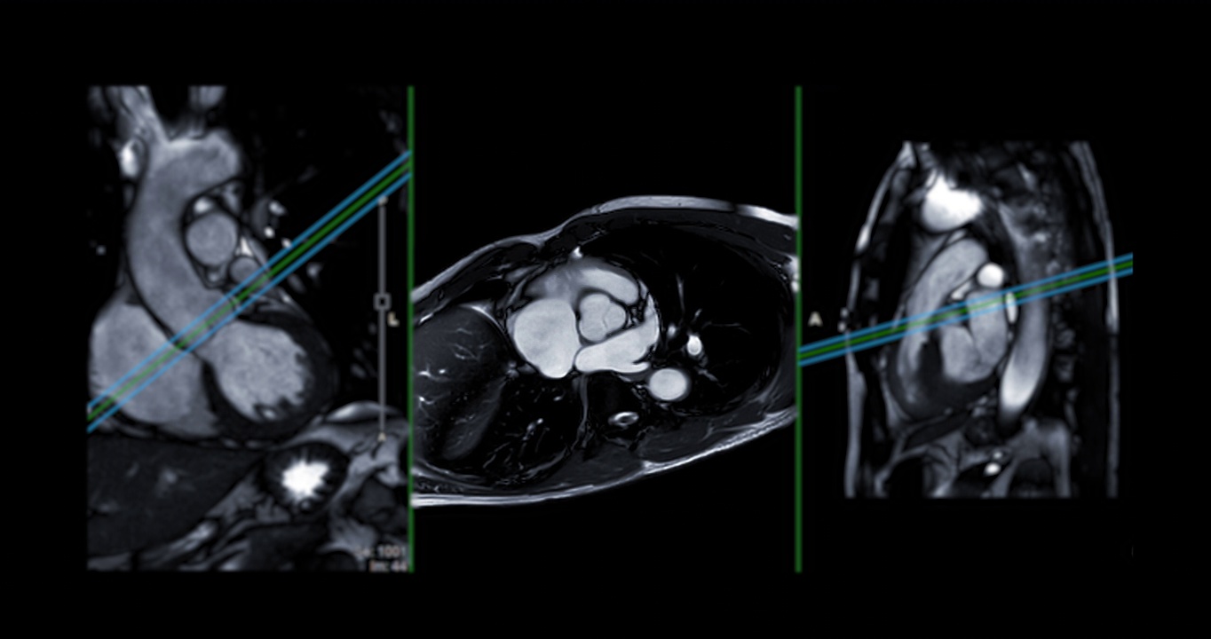 心脏MRI或心脏MRI(磁共振成像)。视频素材