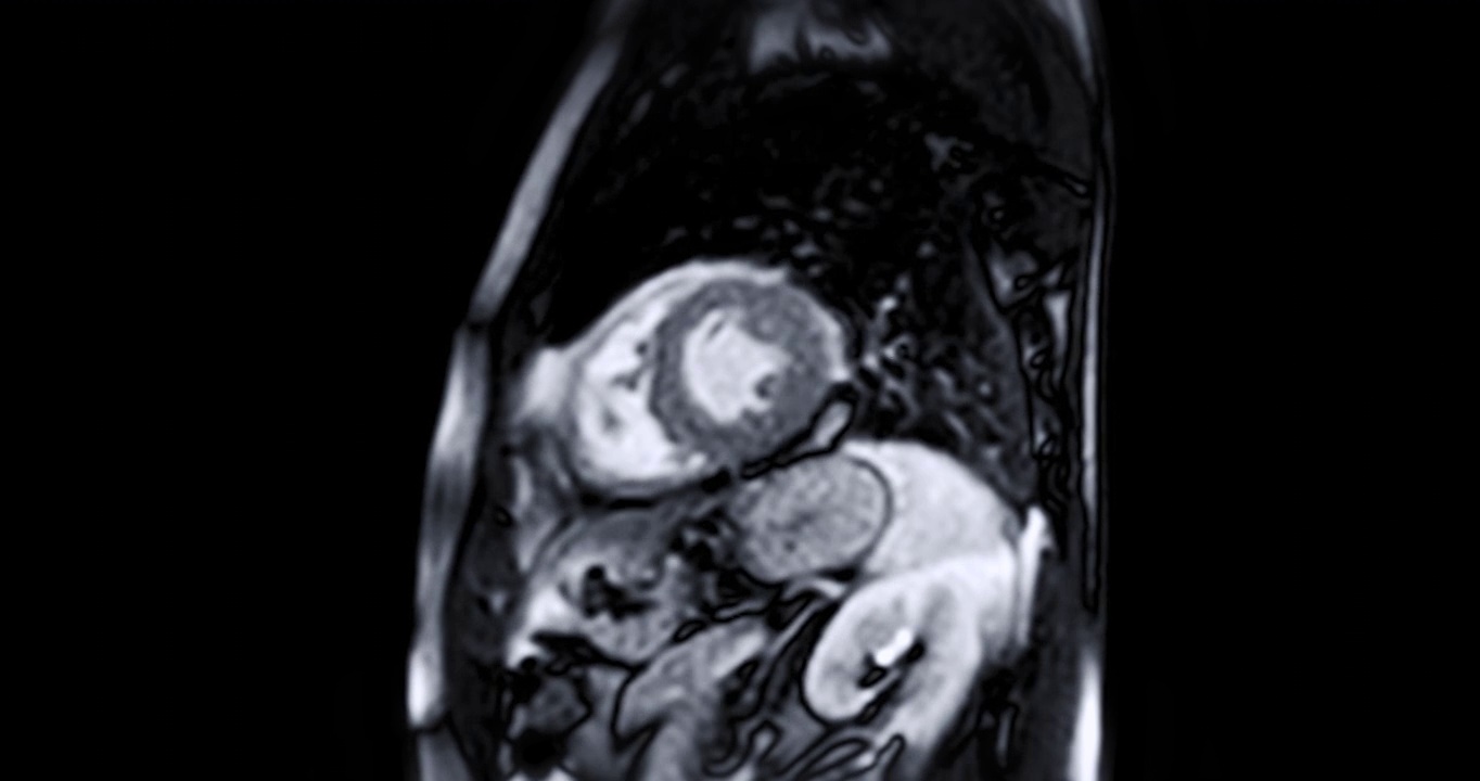 心脏MRI或心脏MRI(磁共振成像)。视频素材