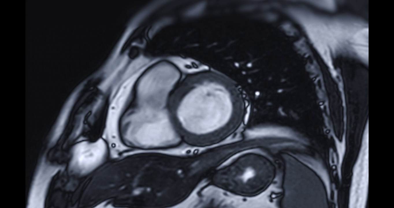 心脏MRI或心脏MRI(磁共振成像)。视频素材