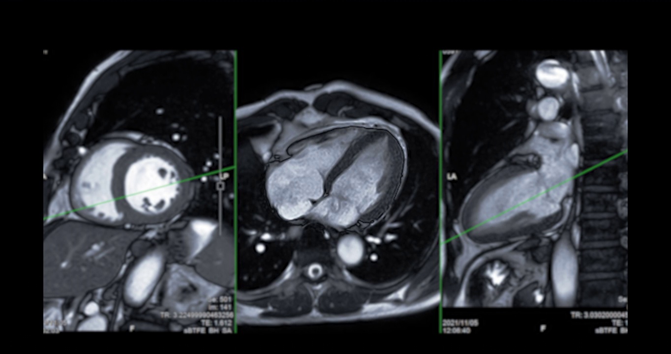 心脏MRI或心脏MRI(磁共振成像)。视频素材