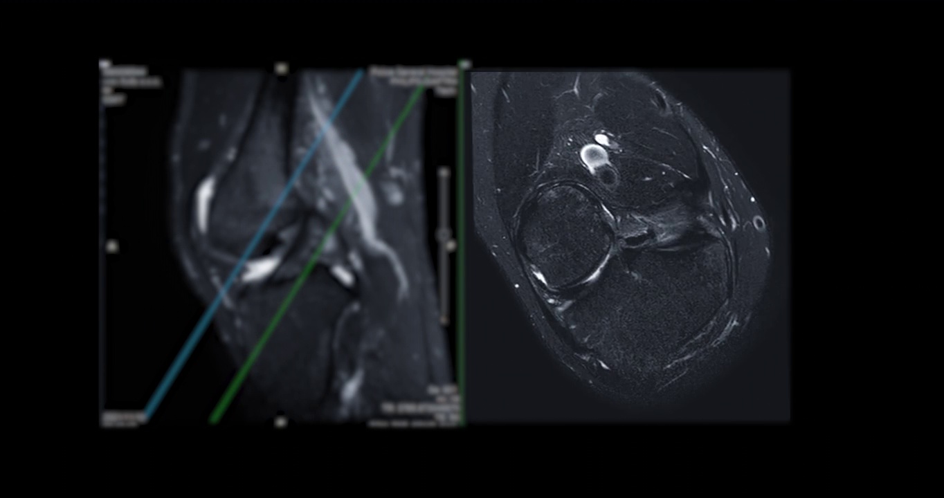 膝关节磁共振成像或膝关节磁共振成像。视频素材