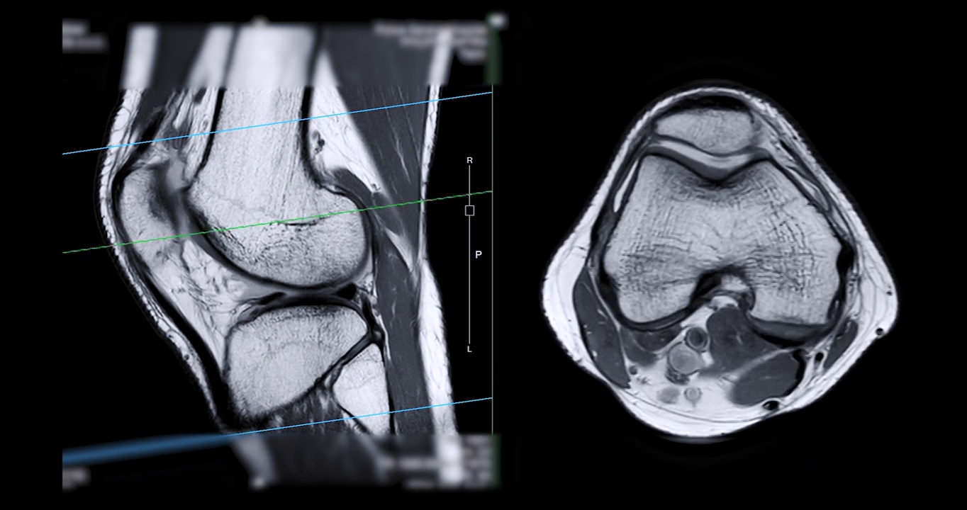 膝关节磁共振成像或膝关节磁共振成像。视频素材