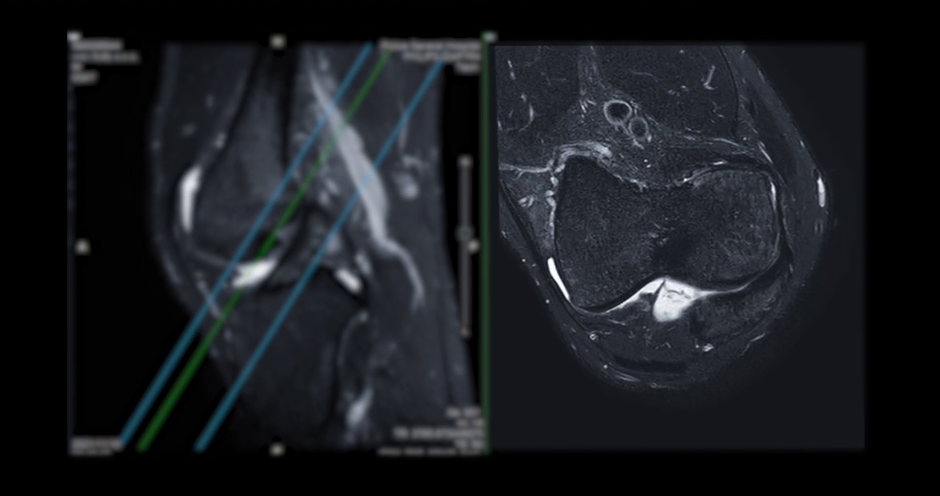 膝关节磁共振成像或膝关节磁共振成像。视频素材