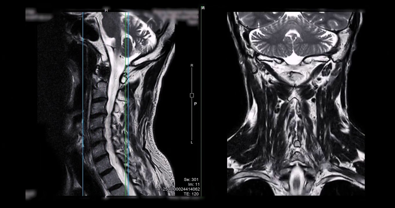 颈椎MRI比较矢状位T2W和冠状位T2W图诊断脊髓受压。视频素材