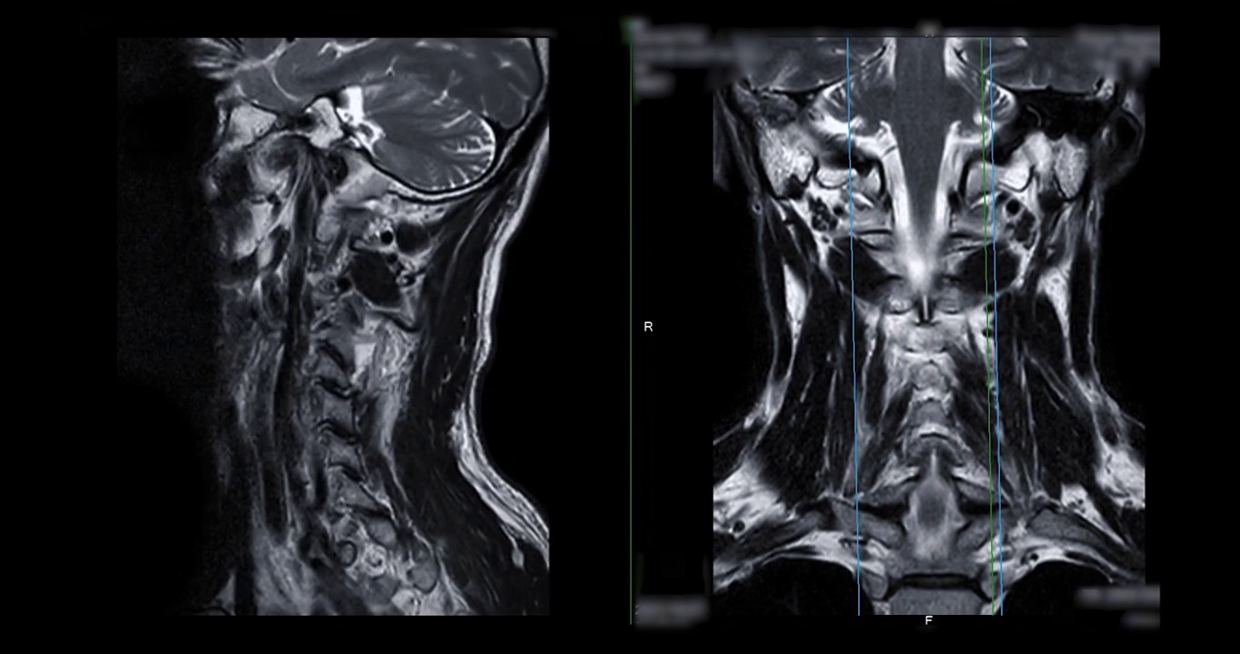 颈椎MRI比较矢状位T2W和冠状位T2W图诊断脊髓受压。视频素材