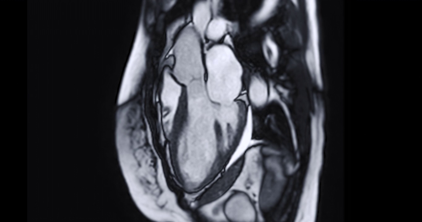 心脏MRI或心脏MRI(核磁共振成像)在垂直长轴视图显示心脏跳动，以检测心脏疾病与主动脉瓣。视频素材