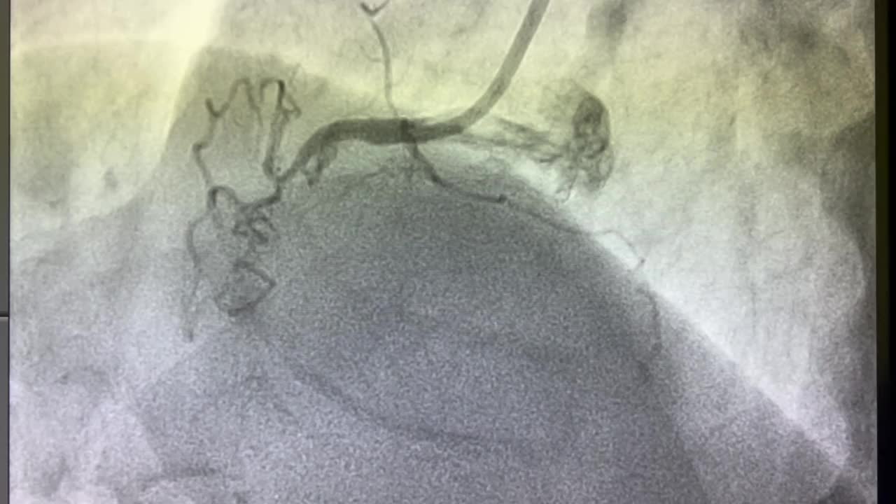 冠状动脉造影，冠状动脉疾病，冠状动脉造影视频素材