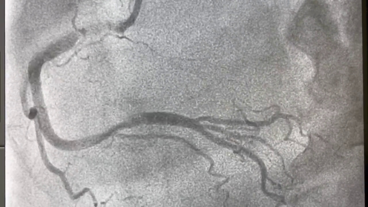 冠状动脉造影，冠状动脉疾病，冠状动脉造影视频下载