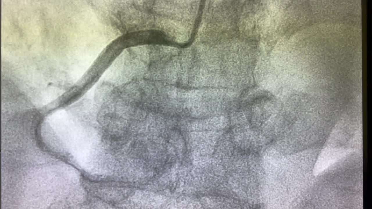 冠状动脉造影，冠状动脉疾病，冠状动脉造影视频素材