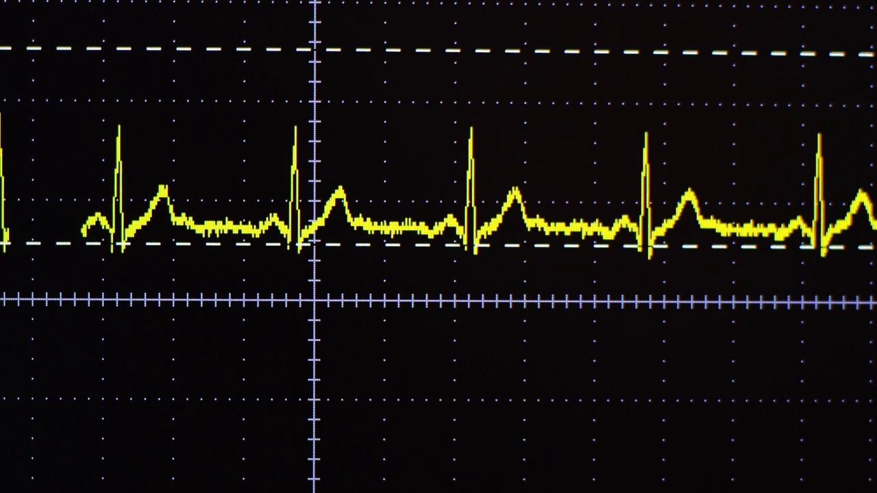 心电图波形视频素材