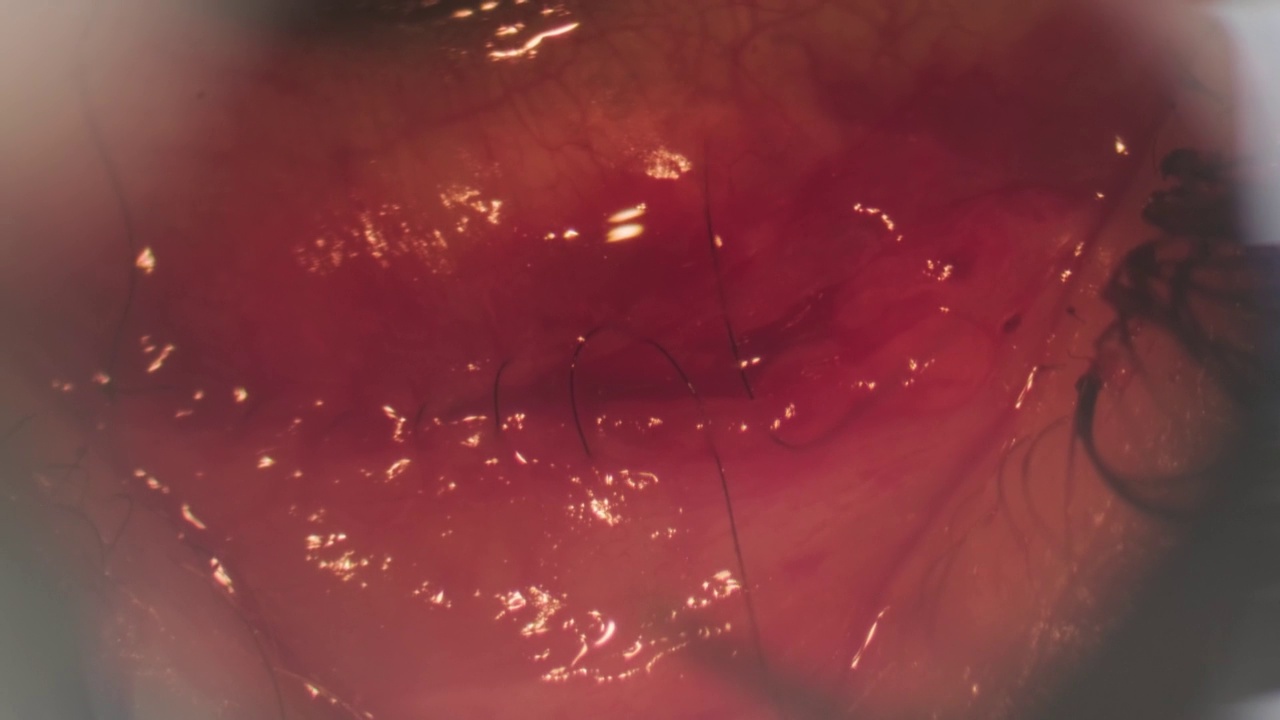 矫正斜视的手术。用显微镜观察。外科医生把眼睛缝起来。Оphthalmic手术视频素材