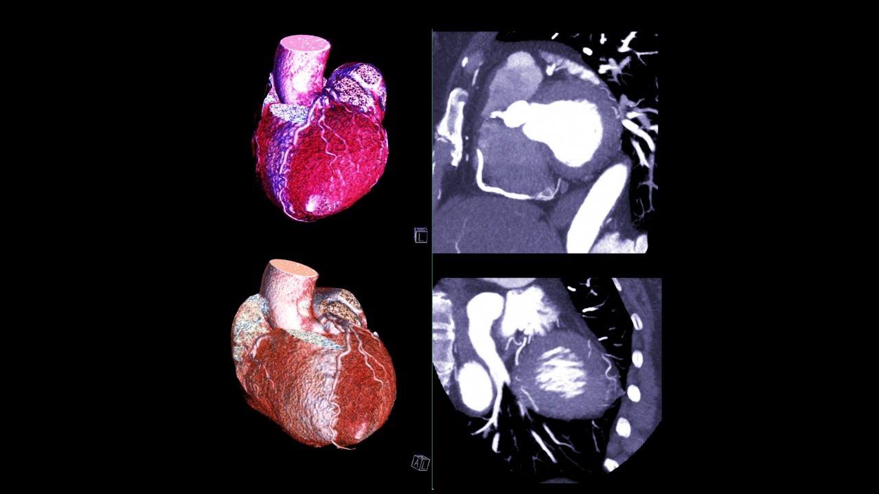 冠状动脉三维绘制。视频素材