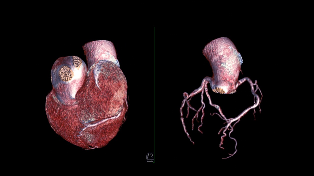 冠状动脉三维绘制。视频素材