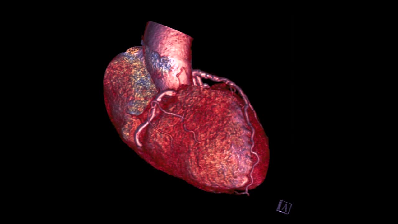冠状动脉三维绘制。视频素材