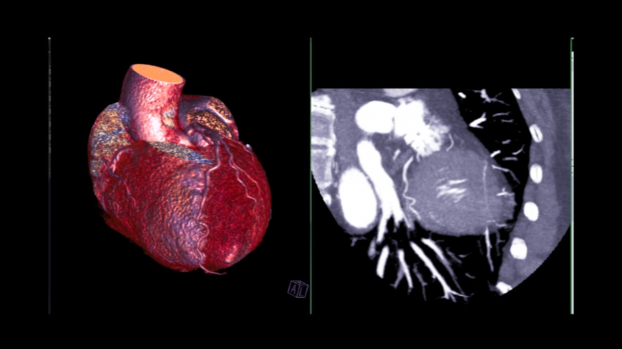 冠状动脉三维绘制。视频素材