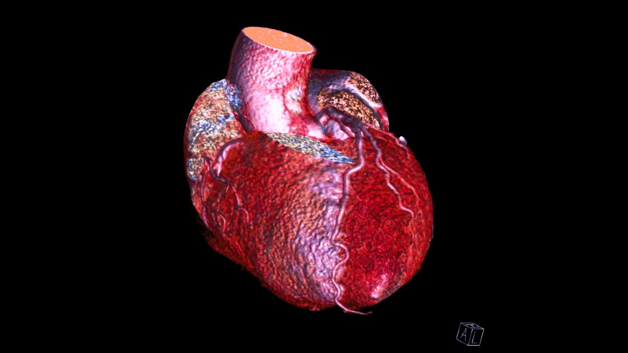冠状动脉三维绘制。视频素材