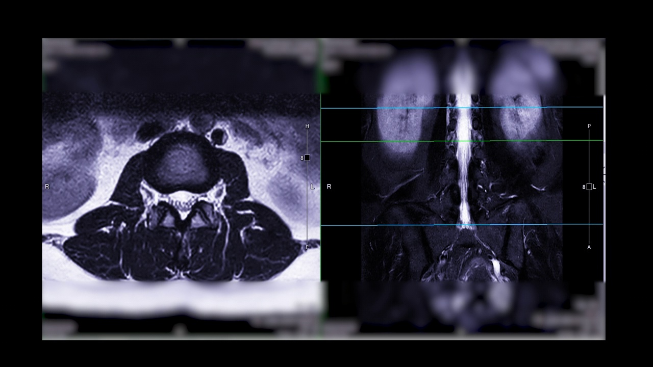 MRI L-S脊柱或腰椎。视频素材