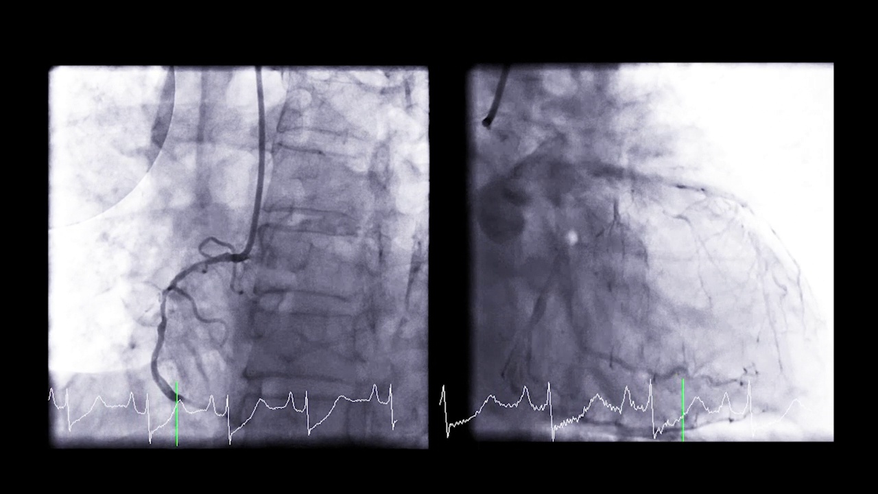 心导管检查是一种检测心脏骤停的方法。视频素材