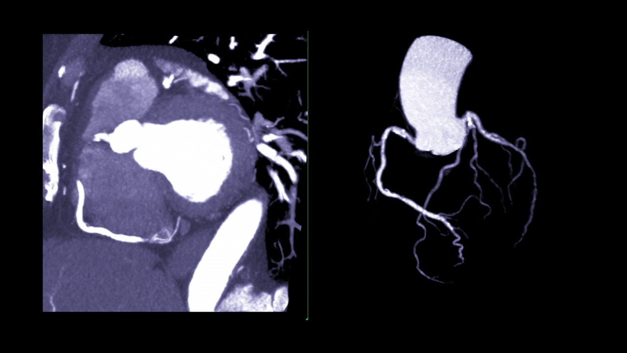 冠状动脉3。视频素材