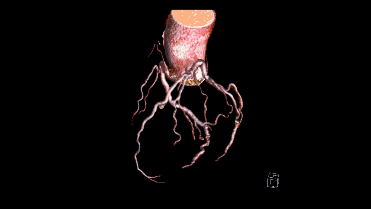 冠状动脉3。视频素材