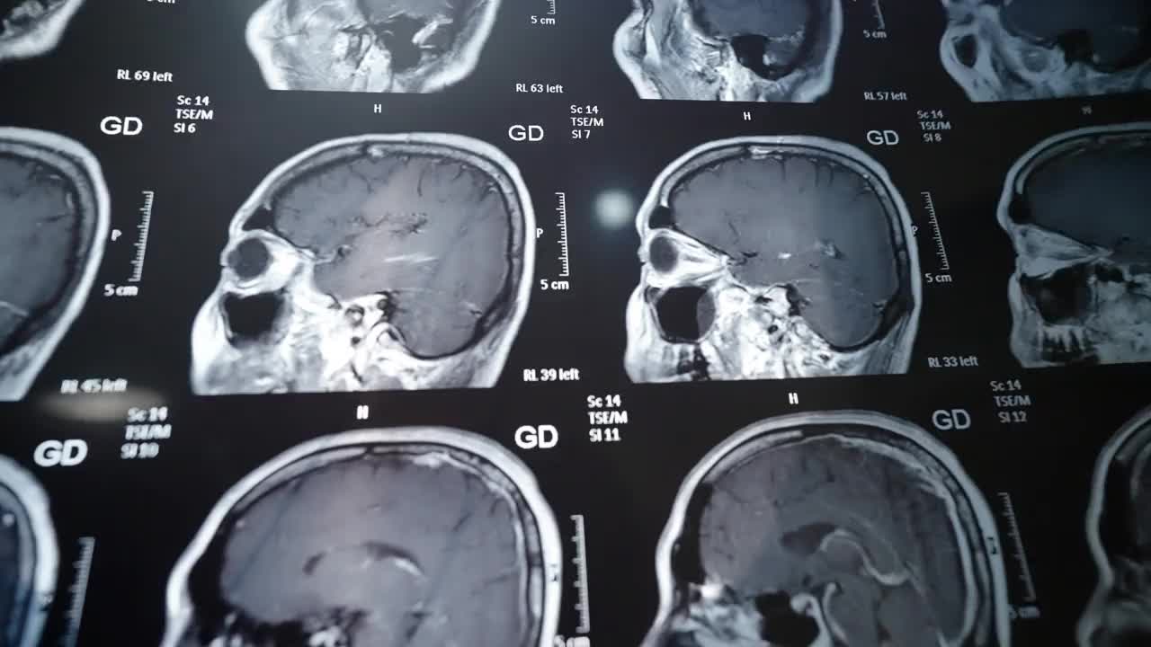 脑部核磁共振。扫描检查肿瘤或癌症。视频素材