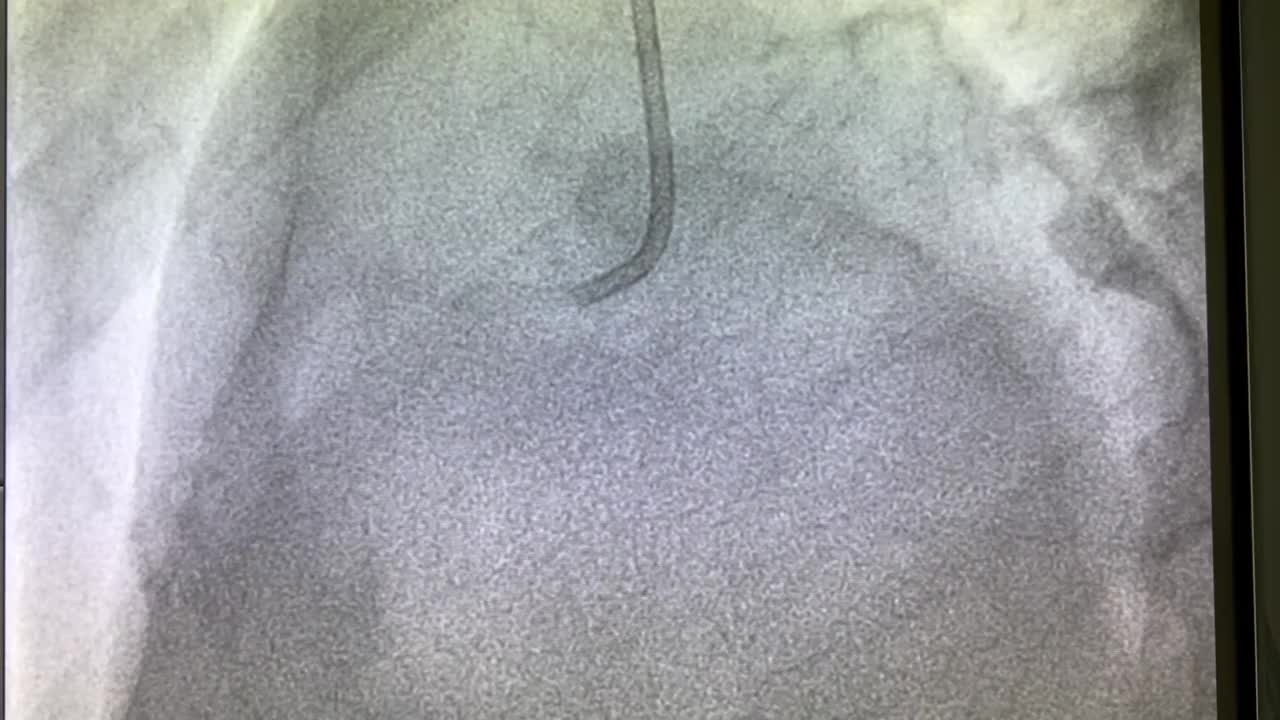 冠状动脉造影视频素材